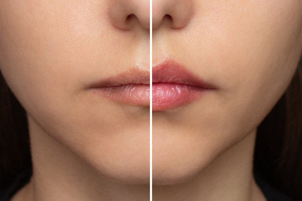 Before and after results of a lip lift