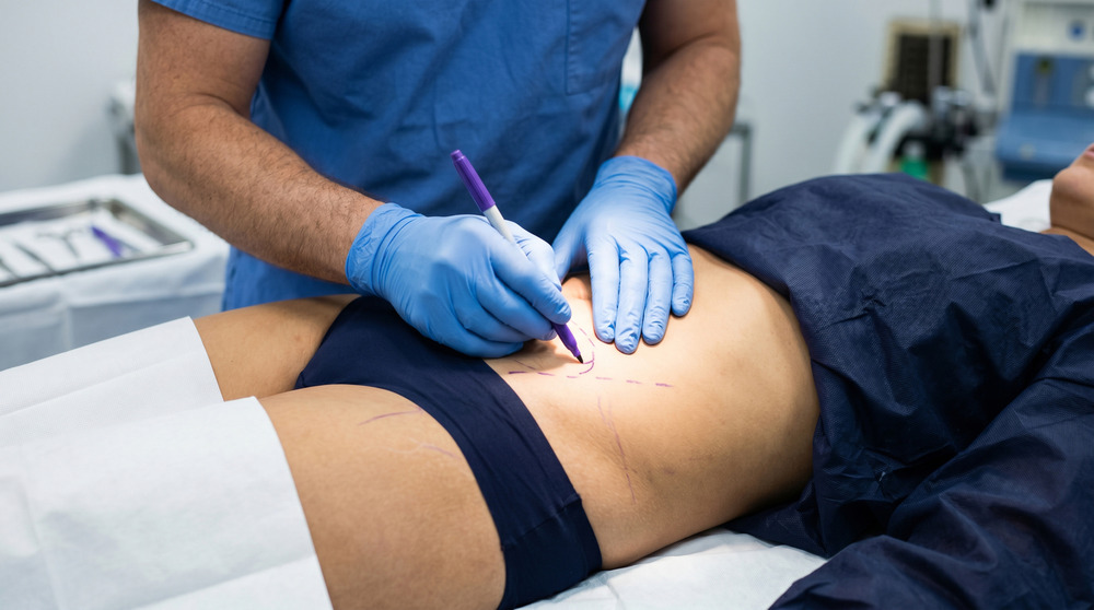 A person on a table being drawn on by a surgeon before carrying out body contouring
