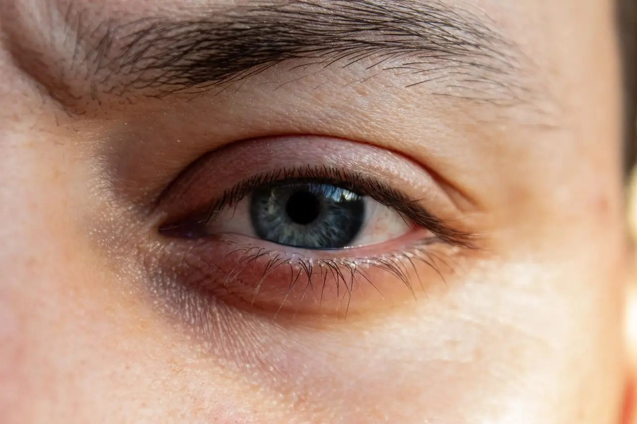 A blue eye with significant eye bags